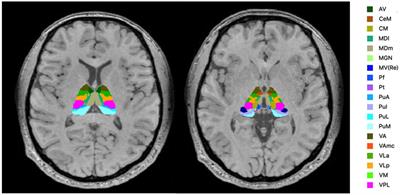 Volumetric assessment of individual thalamic nuclei in patients with drug-naïve, first-episode major depressive disorder